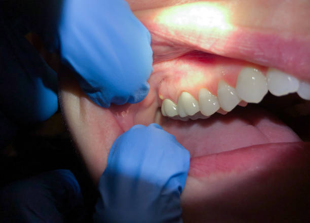 Best Emergency Denture Repair in Pebble Creek, FL